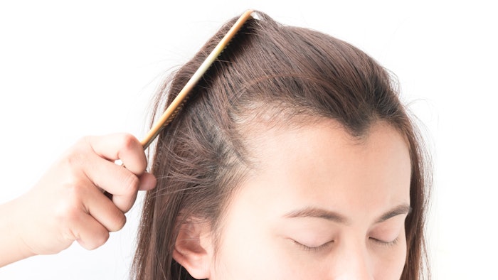Oral vitamin D enhanced the efficacy of minoxidil in patients with female pattern hair loss.