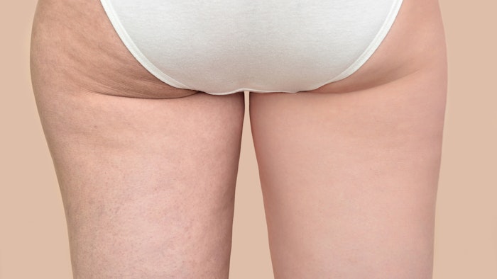 Woman with cellulite