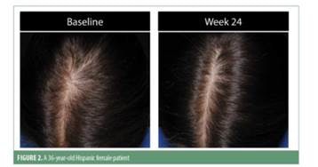 Nutrafol Ethnicity Study Shows Significant Hair Regrowth | MedEsthetics