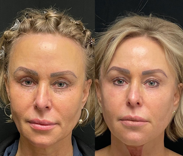 Before and After results using PDO Max Levo Lock threads, provided courtesy of One Aesthetics in Winter Park, FL.