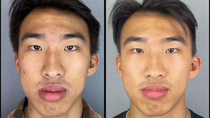 Combining CBD and Retinol is effective in improving skin quality.