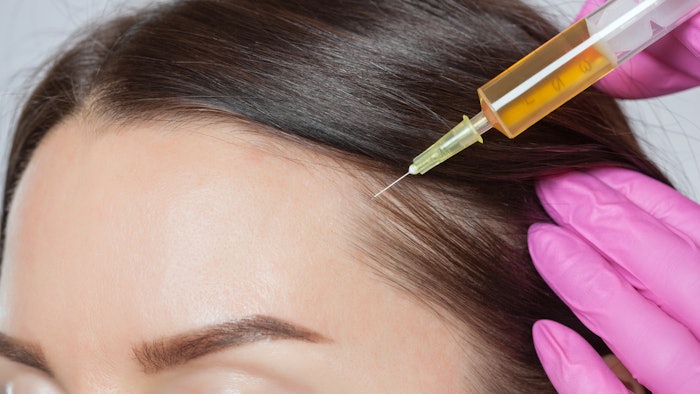 Woman getting PRP injections in hairline