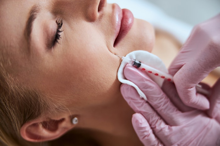 Woman getting filler in her nasolabial folds