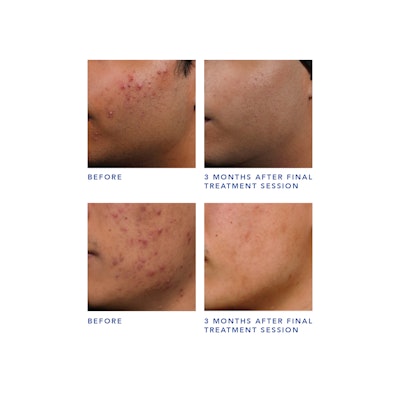 Avi Clear Before And After