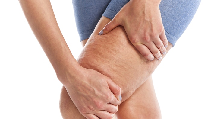 A comparison of five injection techniques revelaed the optimal techniques for cellulite injections on the thighs and buttocks.