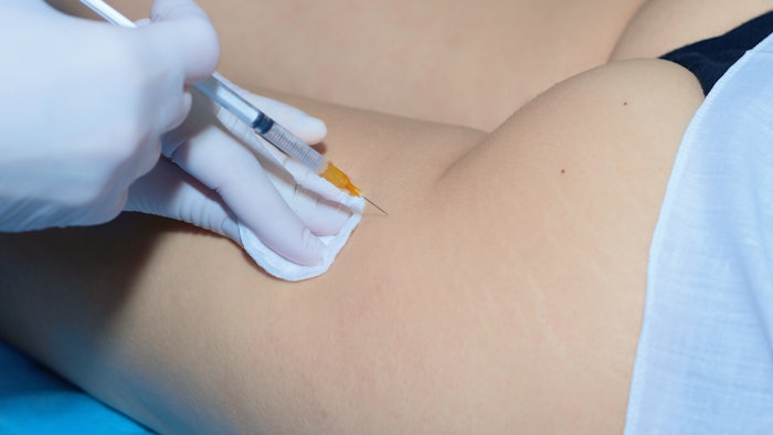 Limited dilute lidocaine anesthesia for minimally invasive cellulite treatment was effective, safe and time efficient.