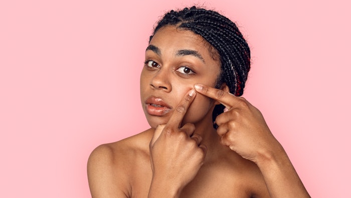 woman popping pimple