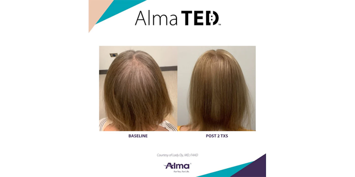 Alma Launches Alma TED Device and Professional CBD Skincare Line ...