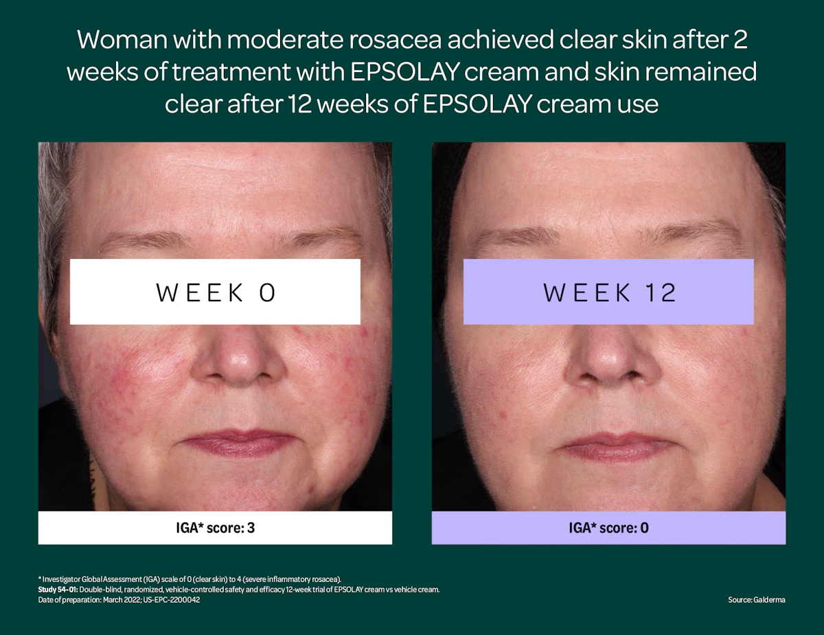 FDA Approves EPSOLAY for Rosacea
