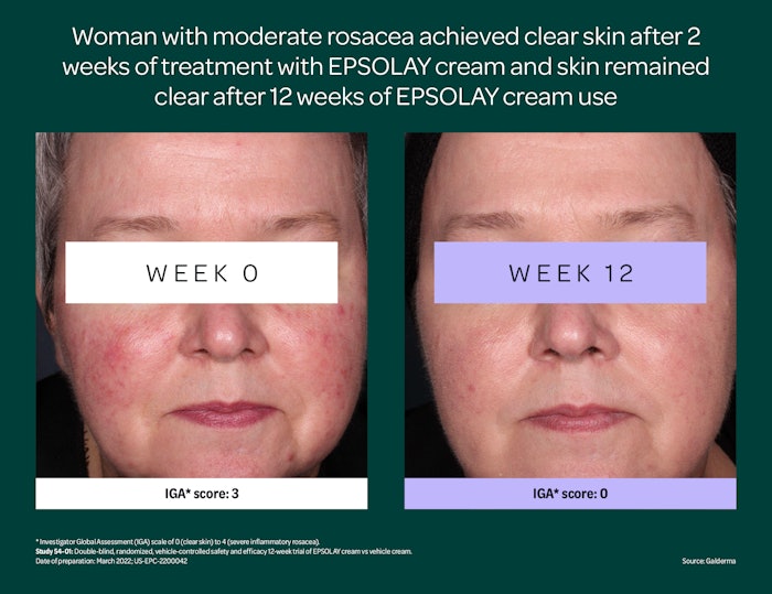 Epsolay Patient Photos 02 Final Us Epc 2200042