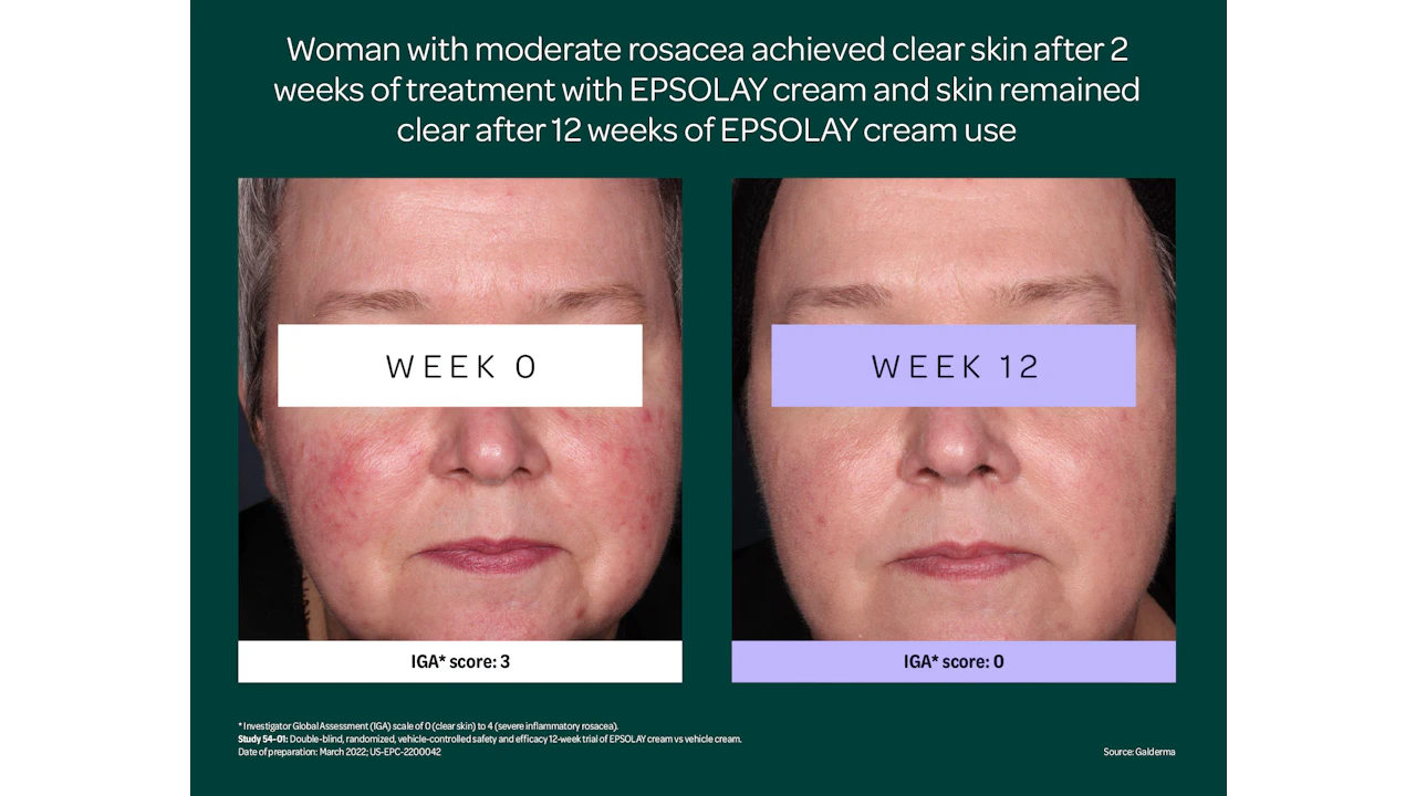 FDA Approves EPSOLAY for Rosacea