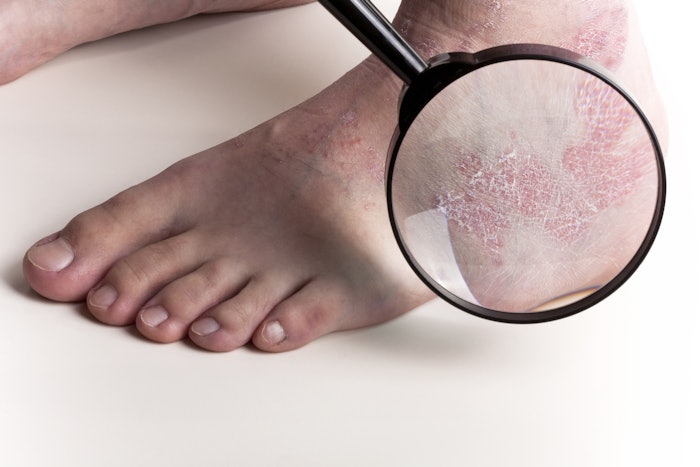 Medical exam on foot with eczema