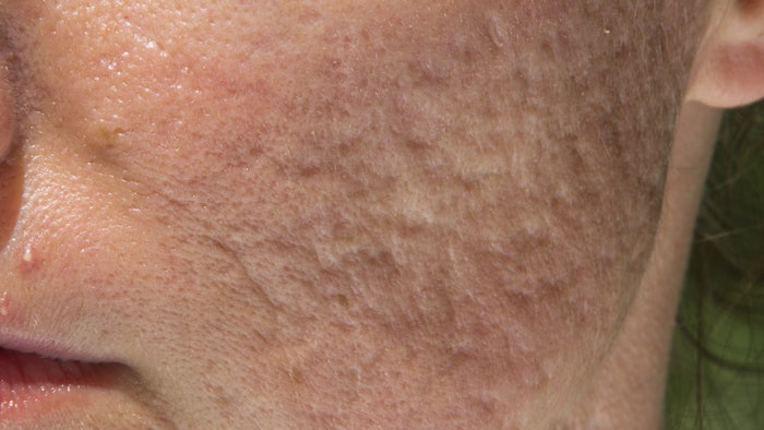 Person with atrophic acne scars