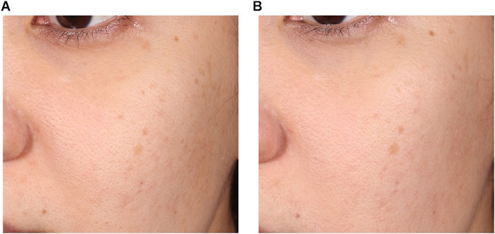 Woman before and after pore size reduction treatment