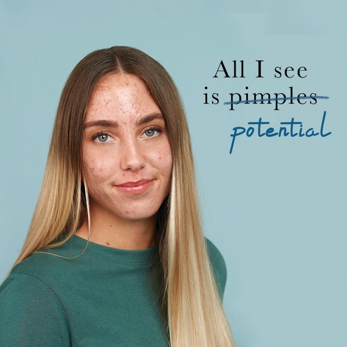 Many respondents in Face Reality's National Acne Survey expressed frustration at social media expectations and ineffective treatments and 95% can't resist picking at their acne.