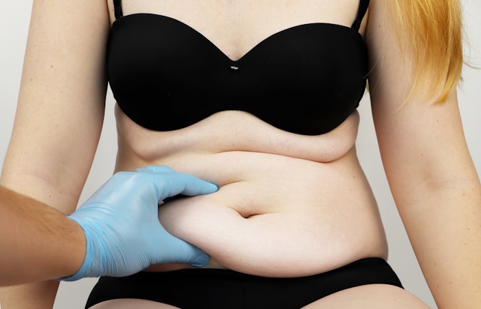 Woman being examined for abdominal liposuction