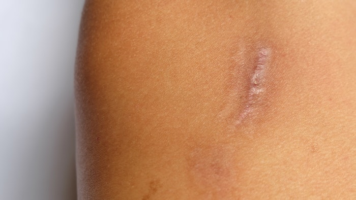 Hypertrophic scar on arm