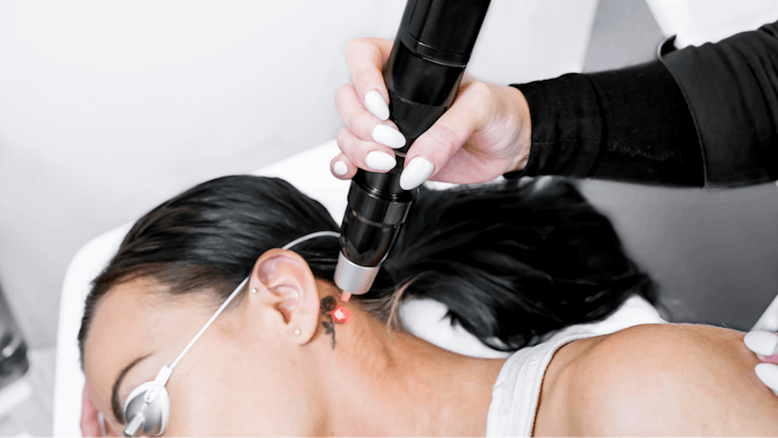 Typically, tattoo removals use unfractionated 1,064-nm picosecond lasers, however, new data suggests a combined treatment with fractionated picosecond lasers may be more effective.
