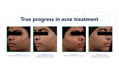 Cutera Me2206 Image1