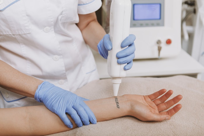Tattoo removal