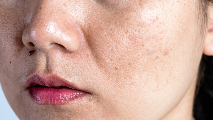 The results of a May 2022 study indicate that combined therapy of LQSNY and drugs or other lasers showed an improved melasma area and severity index.