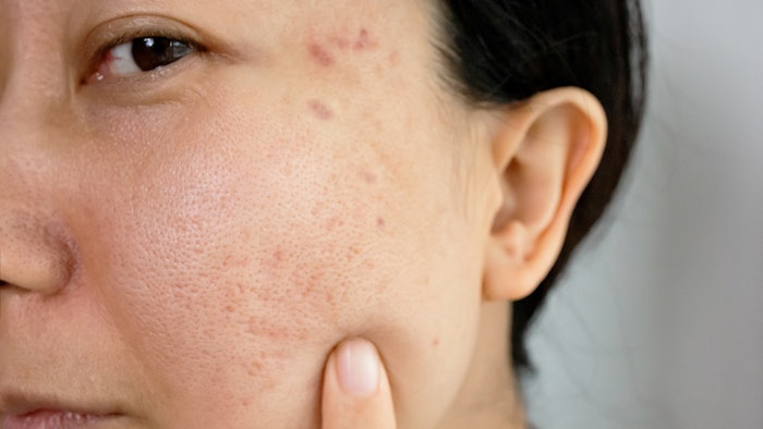 Asian woman with enlarged pores