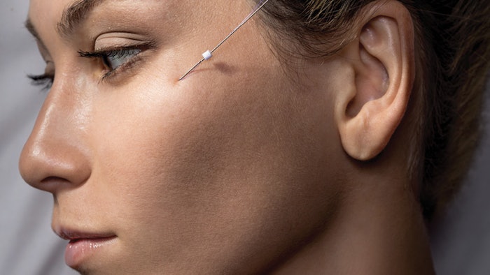 Sculptra Lateral Lift Treatment