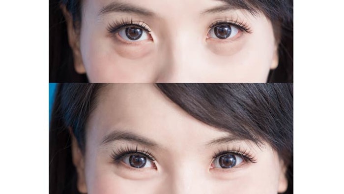 young Asian woman before and after filler injections