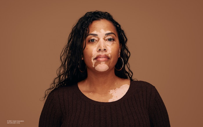 Vitiligo Patient Image
