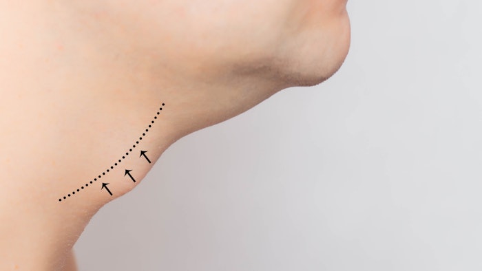 This new technique for reducing the Adam's apple leaves no scar on the neck.