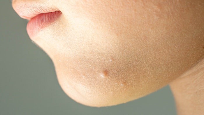 In the study, 32.4% of Molluscum patients using Novan's berdamizer gel achieved complete clearance of lesions after 12 weeks.