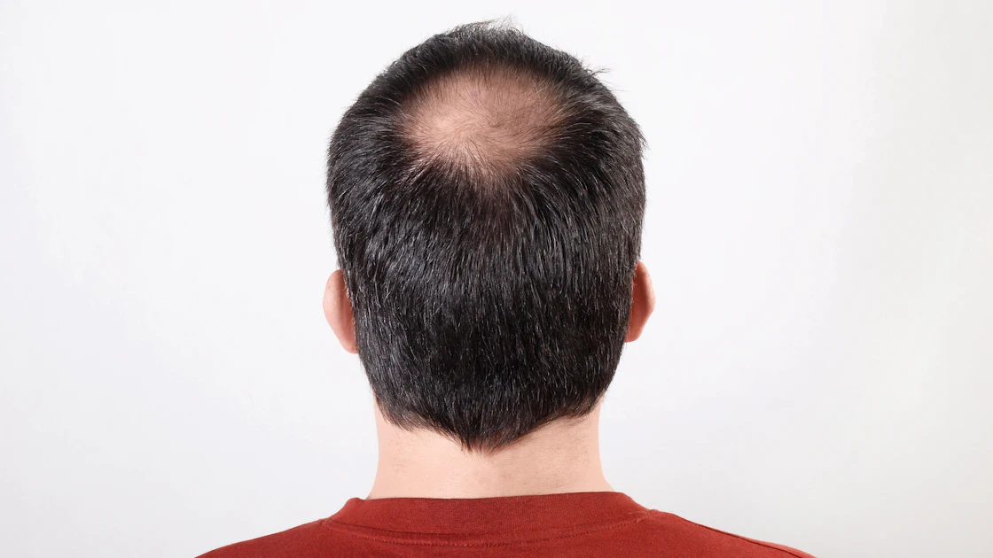 Male Hair Thinning Insight by Gökhan Vayni