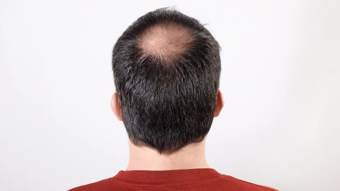 balding man with thinning hair