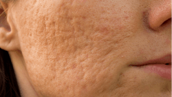 woman with acne scars