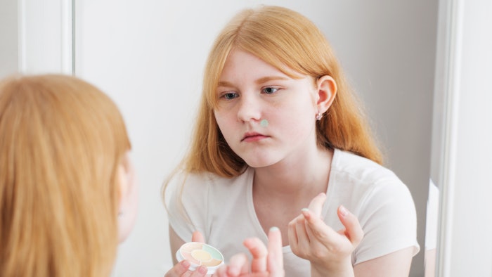teen girl with acne using skin care product