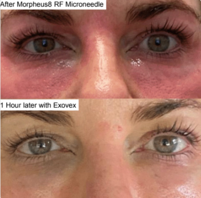 Exovex is designed to be applied after microneedling and energy-based treatments.