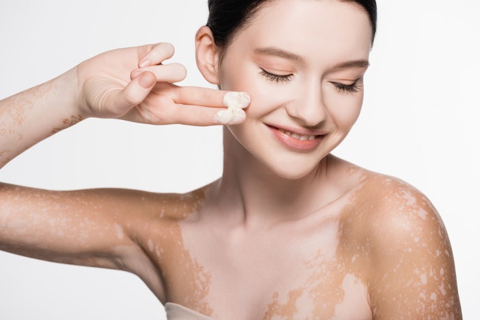 The Phase 3 TRuE-V clinical trial results demonstrated significant improvements in facial and total body repigmentation with ruxolitinib cream.