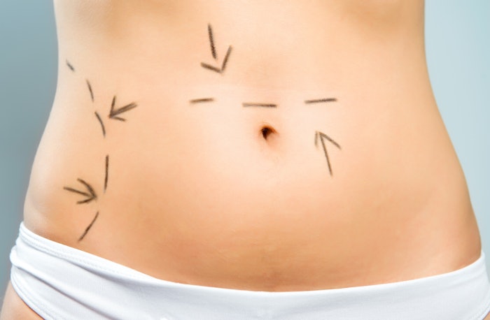 A novel professional aesthetic scale for the female abdomen was designed to help plastic surgeons and physicians tailor treatment options to meet individual patient goals.