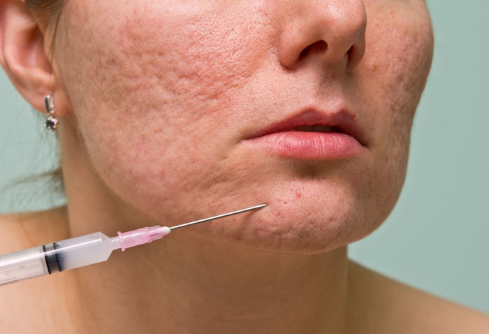 woman treating acne with injection