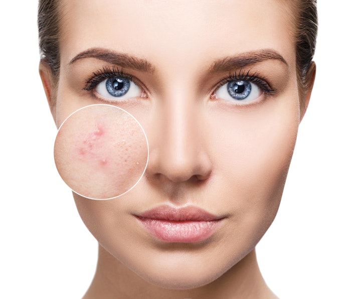 Accure Acne announced its FDA clearance for its Accure Laser System to treat mild to severe inflammatory acne vulgaris.