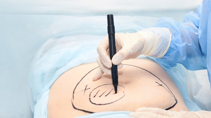 doctor prepping patient for liposuction procedure