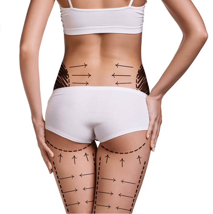 An advanced fat transfer technique developed by Bill Johnson, M.D., offers the option of safer, more natural breast enhancements and brazilian butt lifts.