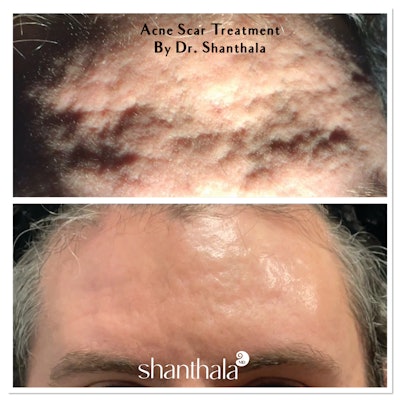 Before and After image of an acne scar treatment by Dr. Shanthala Shivananjappa.