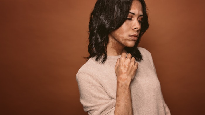 woman suffering from vitiligo skin condition