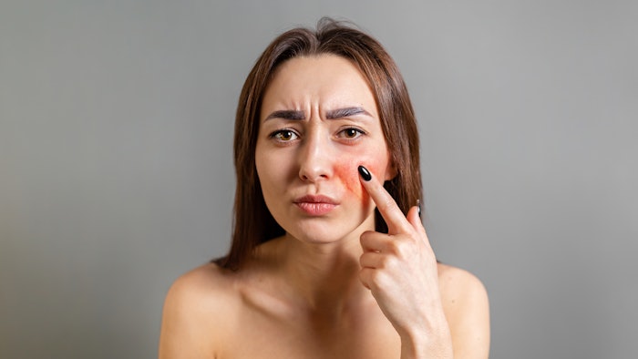 This week's top trending Google Trends search on Kalme Skin Care indicates consumer interest in rosacea and sensitive skin care.