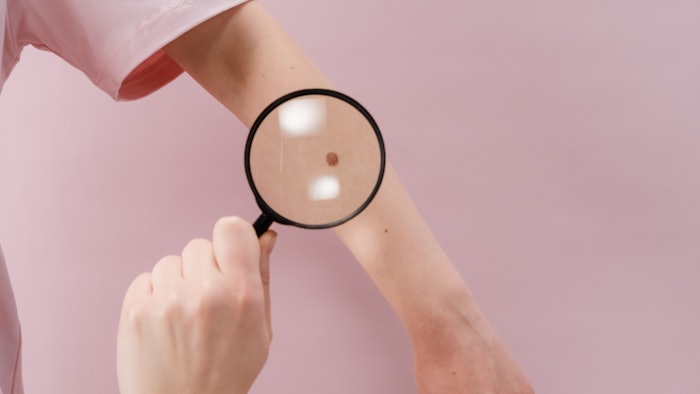 DermTech Melanoma Test Now Covering 9M Additional Lives with Veteran’s Health Association