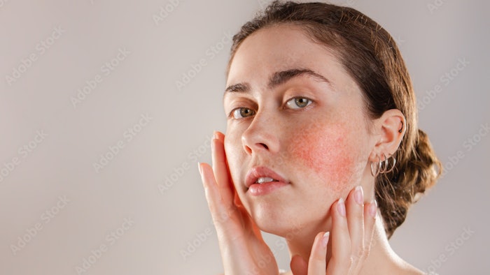 Journey Medical Completes Enrollment in Phase 3 Clinical Trials Evaluating DFD-29 for the Treatment of Papulopustular Rosacea