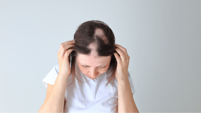 New phase 3 clinical data found significant improvements in scalp hair regrowth after 24 weeks for patients taking deuruxolitnib twice daily.