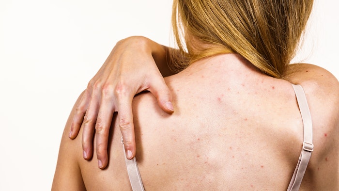 Fungal acne and acne vulgaris can look similar, but require different medications to treat.