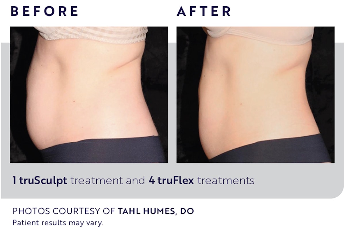 truBody Offers Multidimensional Approach to Body Contouring